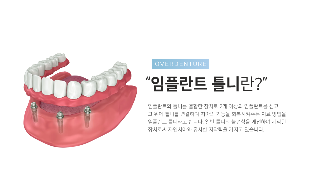 ���ö�ƮƲ��