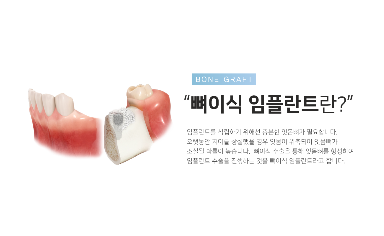 ���̽����ö�Ʈ